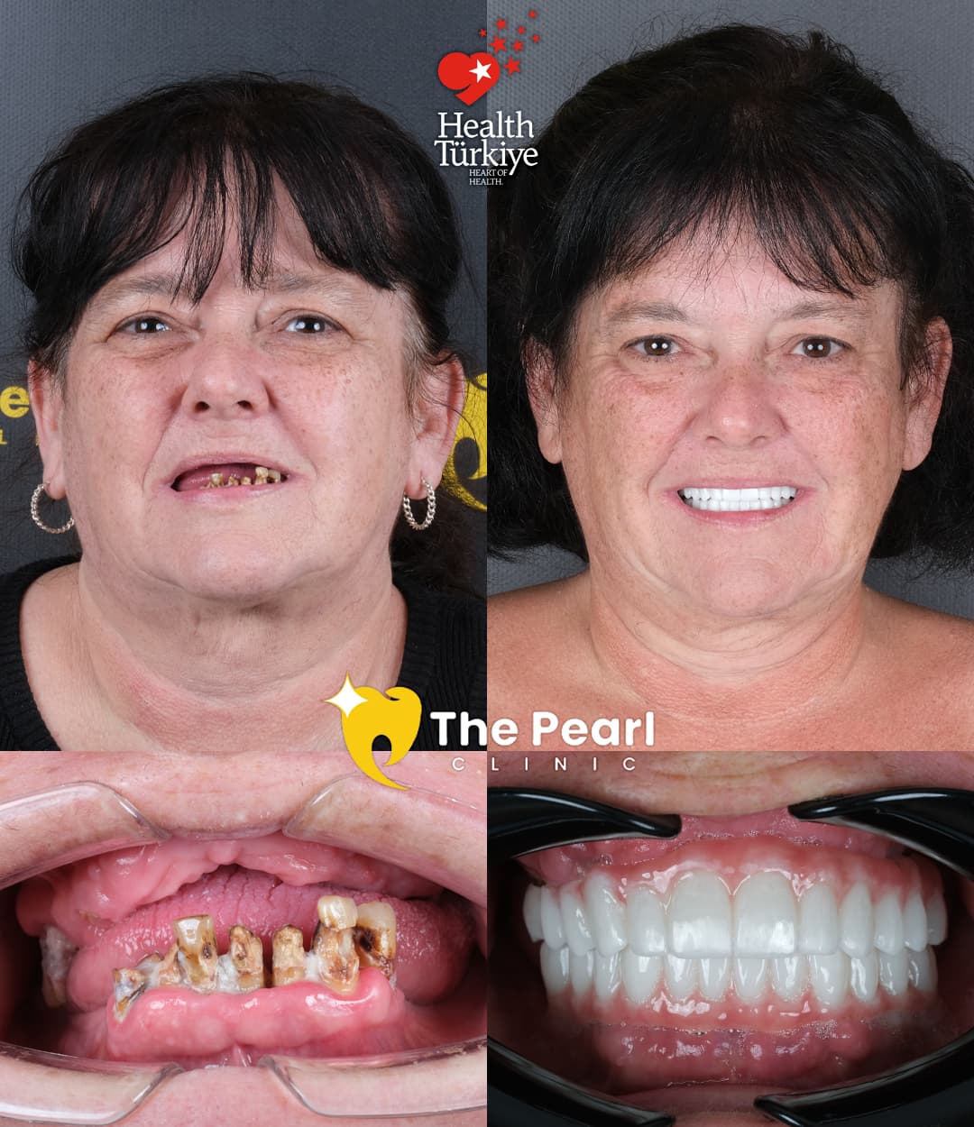Full smile restoration dental implants